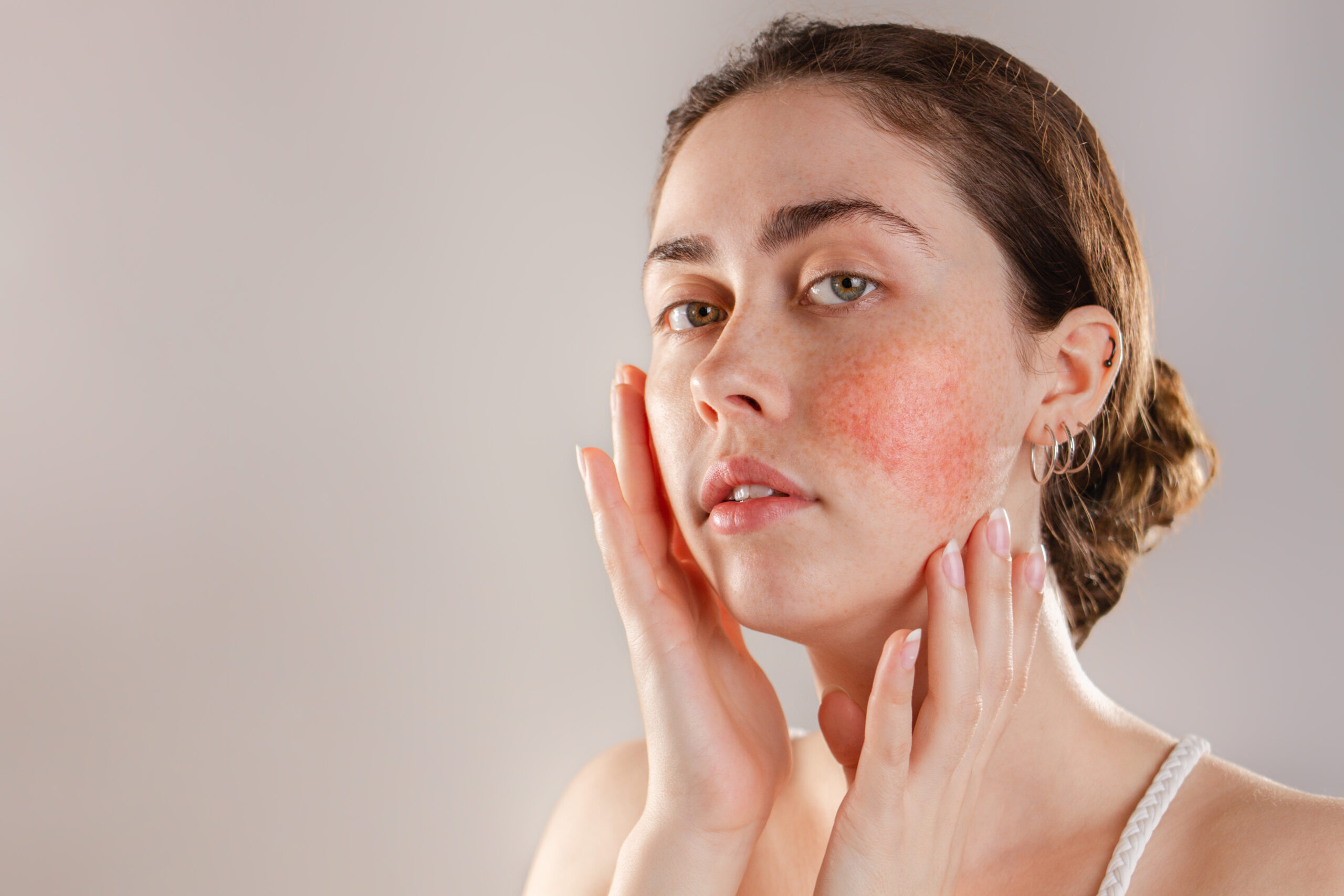 Portrait of senior and young woman Medicine and cosmetology. Portrait of a young beautiful brunette woman with rosacea on her cheeks. Copy space